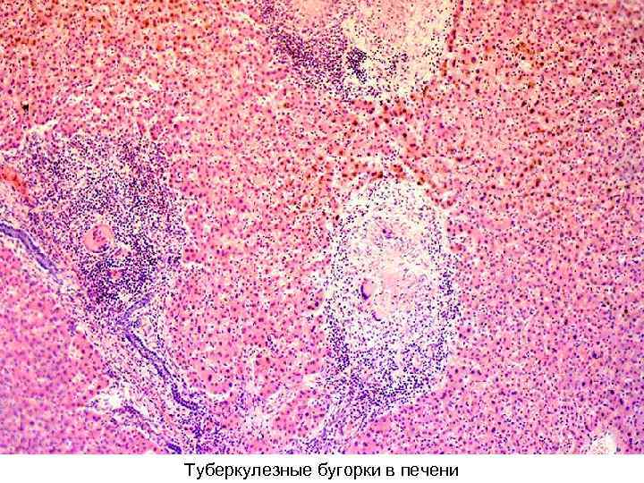Туберкулезные бугорки в печени 
