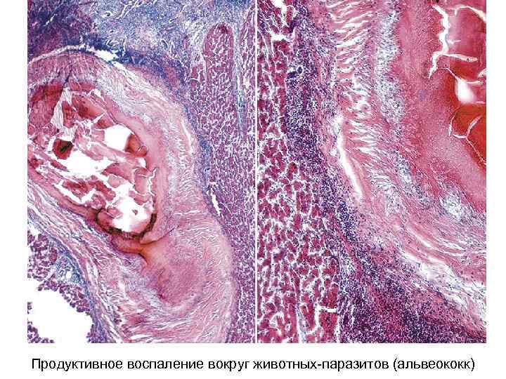 Продуктивное воспаление вокруг животных-паразитов (альвеококк) 