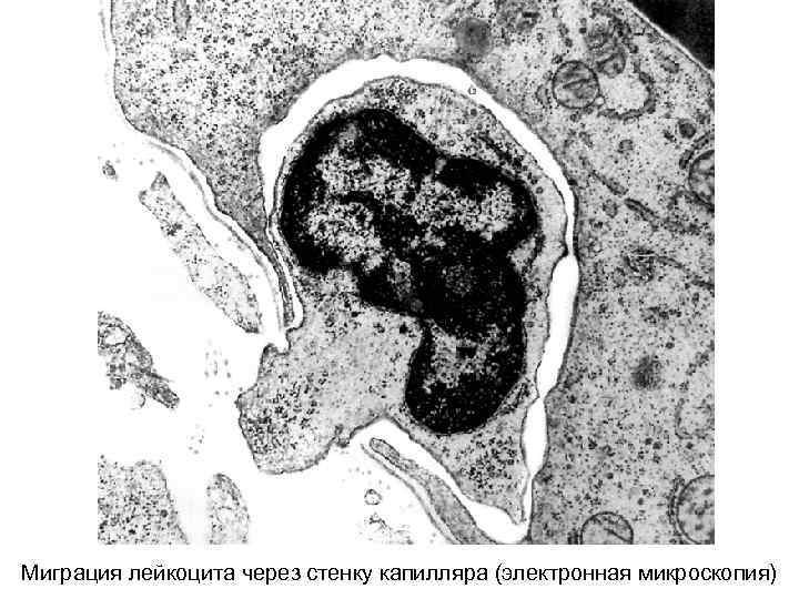 Миграция лейкоцита через стенку капилляра (электронная микроскопия) 