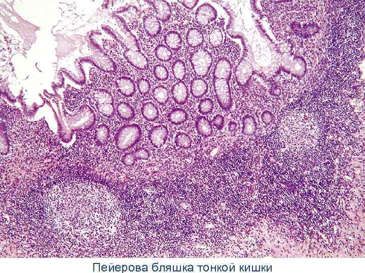 Пейерова бляшка тонкой кишки 