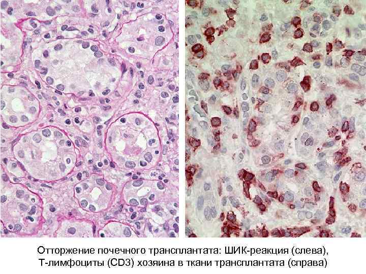 Отторжение почечного трансплантата: ШИК-реакция (слева), Т-лимфоциты (CD 3) хозяина в ткани трансплантата (справа) 