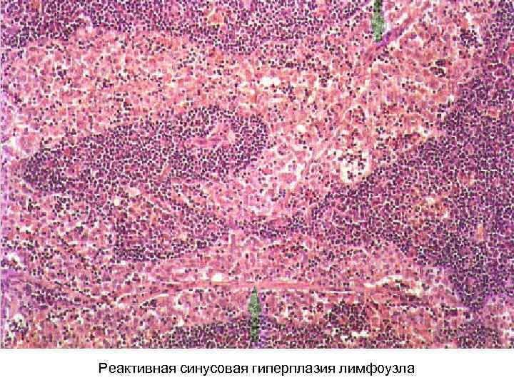 Реактивная синусовая гиперплазия лимфоузла 