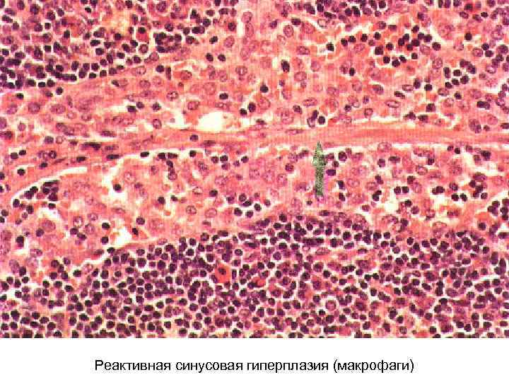 Реактивная синусовая гиперплазия (макрофаги) 