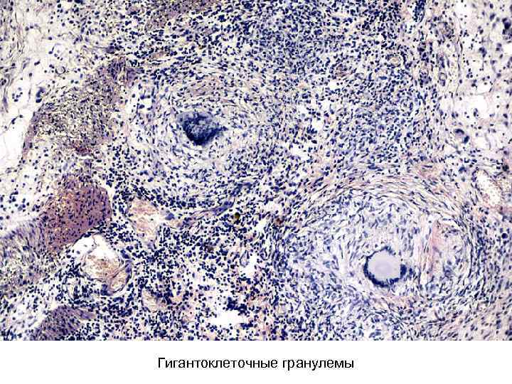 Гигантоклеточные гранулемы 