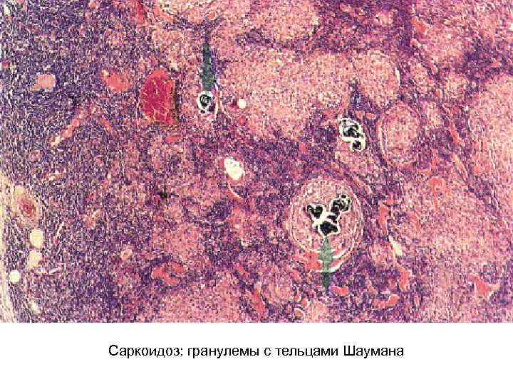 Саркоидоз: гранулемы с тельцами Шаумана 