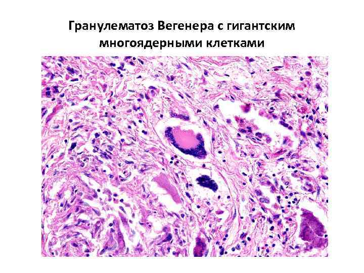 Гранулематоз Вегенера с гигантским многоядерными клетками 