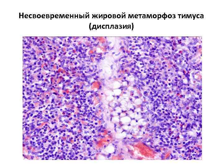 Несвоевременный жировой метаморфоз тимуса (дисплазия) 