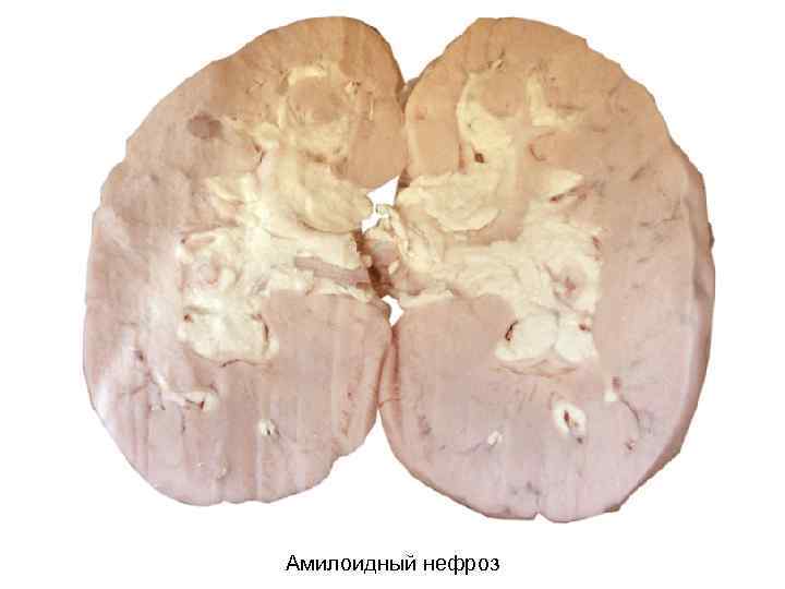 Амилоидный нефроз 