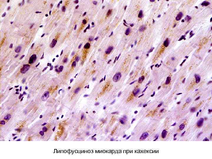 Липофусциноз миокарда при кахексии 