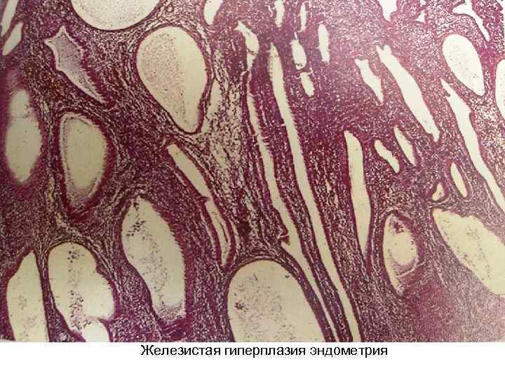 Железистая гиперплазия эндометрия 