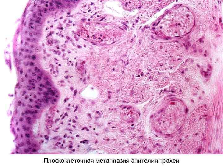 Плоскоклеточный эндометрий. Плоскоклеточная метаплазия гистология. Базальноклеточная карцинома гистология. Метаплазированный эпителий шейки матки. Плоскоклеточный метаплазированный эпителий.