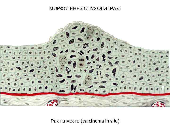 МОРФОГЕНЕЗ ОПУХОЛИ (РАК) Рак на месте (carcinoma in situ) 