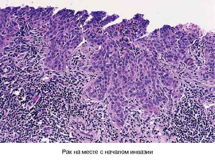 Рак на месте с началом инвазии 