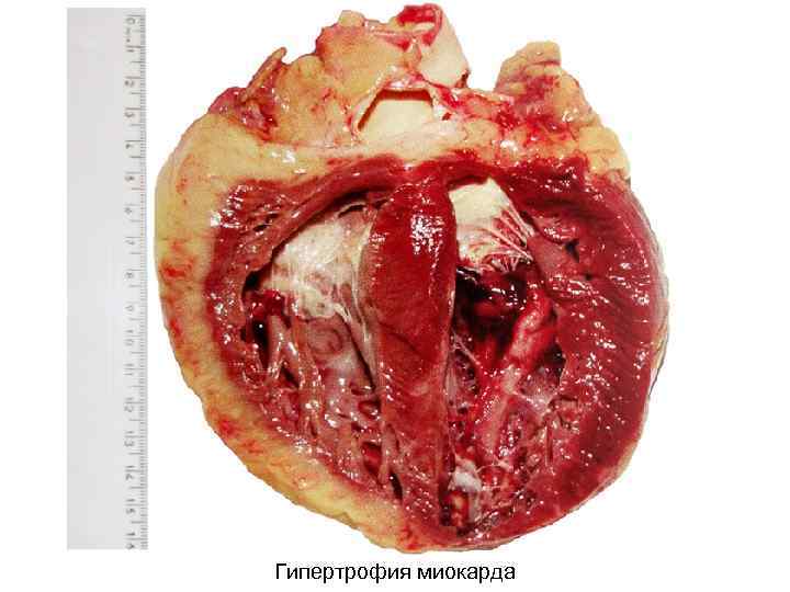 Гипертрофия миокарда 