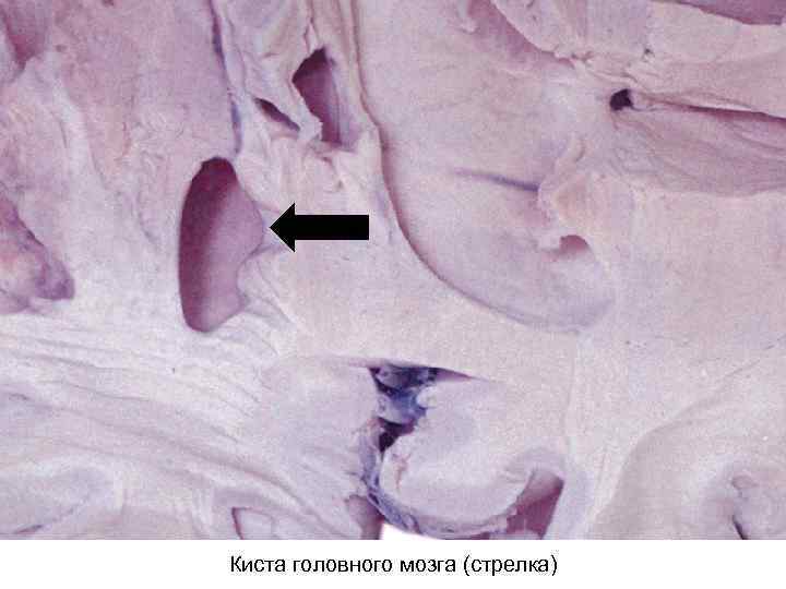 Киста головного мозга (стрелка) 