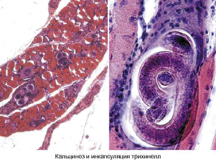 Кальциноз и инкапсуляция трихинелл 