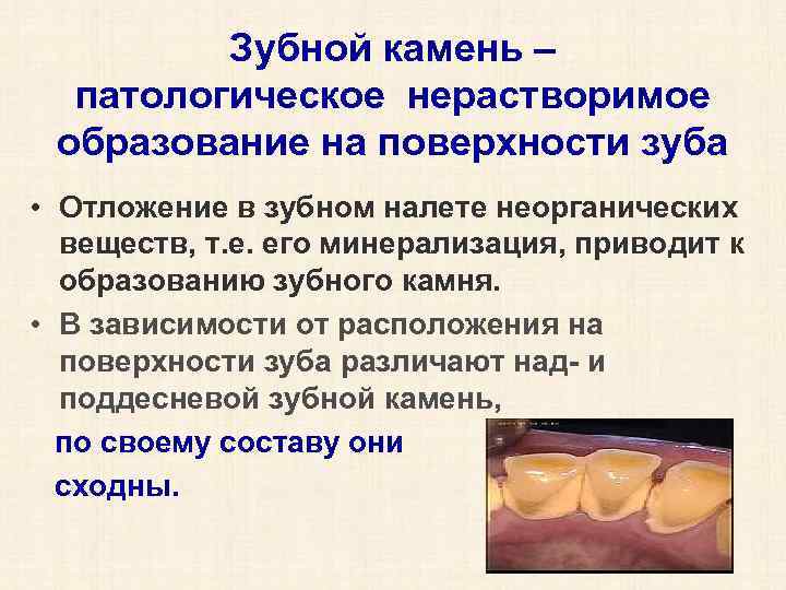 Зубной камень – патологическое нерастворимое образование на поверхности зуба • Отложение в зубном налете