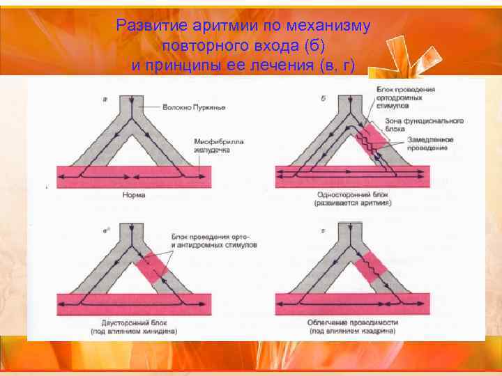 Развитие аритмии по механизму повторного входа (б) и принципы ее лечения (в, г) 