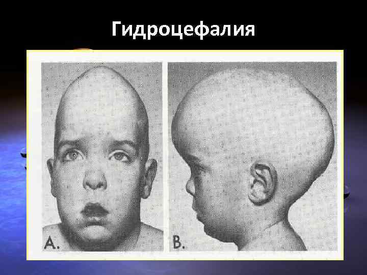 Гидроцефалия 