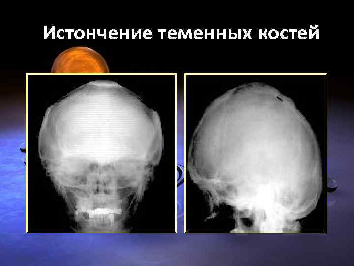 Перелом теменной кости у грудного. Перелом теменной кости черепа. Остеопороз черепа рентген. Истончение теменных костей. Перелом костей черепа рентген.