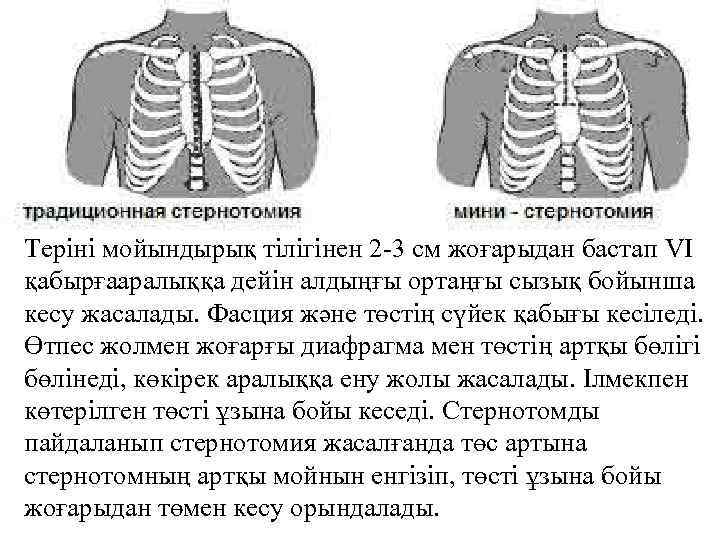 Теріні мойындырық тілігінен 2 -3 см жоғарыдан бастап VI қабырғааралыққа дейін алдыңғы ортаңғы сызық