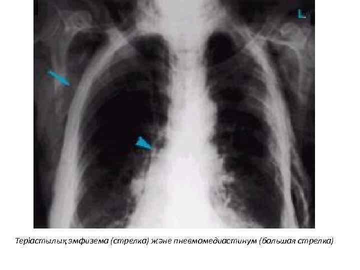 Теріастылық эмфизема (стрелка) және пневмомедиастинум (большая стрелка) 