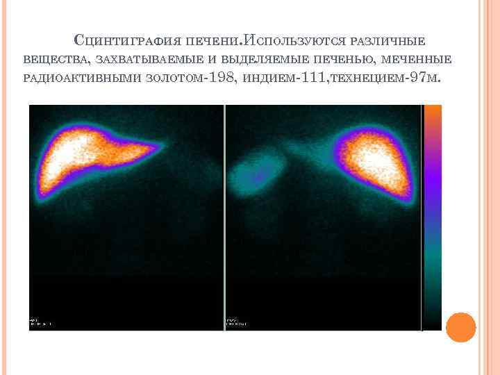 СЦИНТИГРАФИЯ ПЕЧЕНИ. ИСПОЛЬЗУЮТСЯ РАЗЛИЧНЫЕ ВЕЩЕСТВА, ЗАХВАТЫВАЕМЫЕ И ВЫДЕЛЯЕМЫЕ ПЕЧЕНЬЮ, МЕЧЕННЫЕ РАДИОАКТИВНЫМИ ЗОЛОТОМ-198, ИНДИЕМ-111, ТЕХНЕЦИЕМ-97