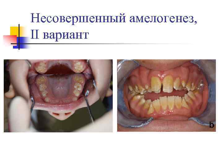 Несовершенный амелогенез, II вариант 