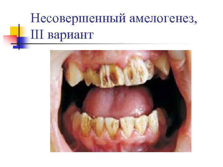 Несовершенный амелогенез, III вариант 