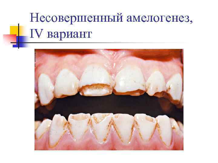 Несовершенный амелогенез, IV вариант 