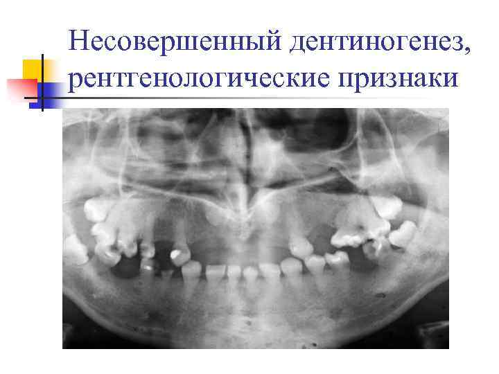 Несовершенный дентиногенез, рентгенологические признаки 