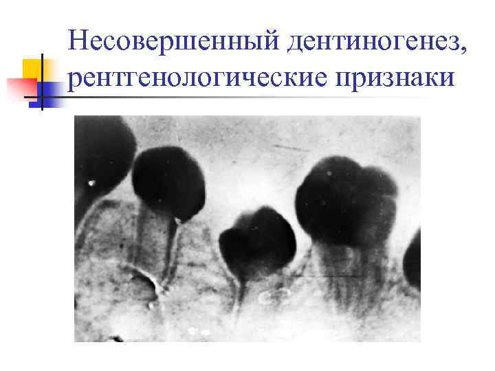 Несовершенный дентиногенез, рентгенологические признаки 