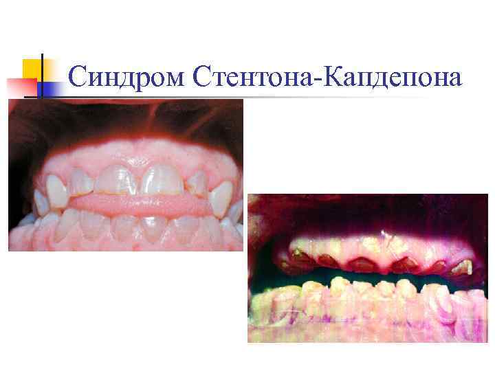 Синдром Стентона-Капдепона 