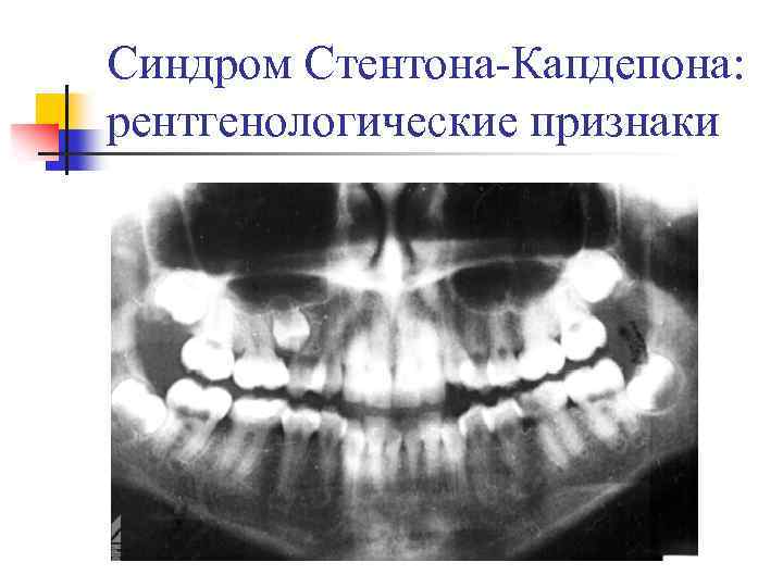 Синдром Стентона-Капдепона: рентгенологические признаки 