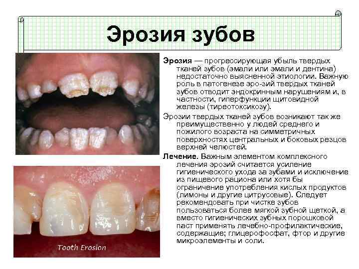 Эрозия зубов картинки