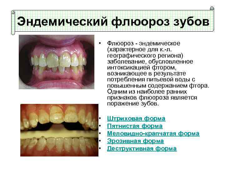 Флюороз на зубах фото