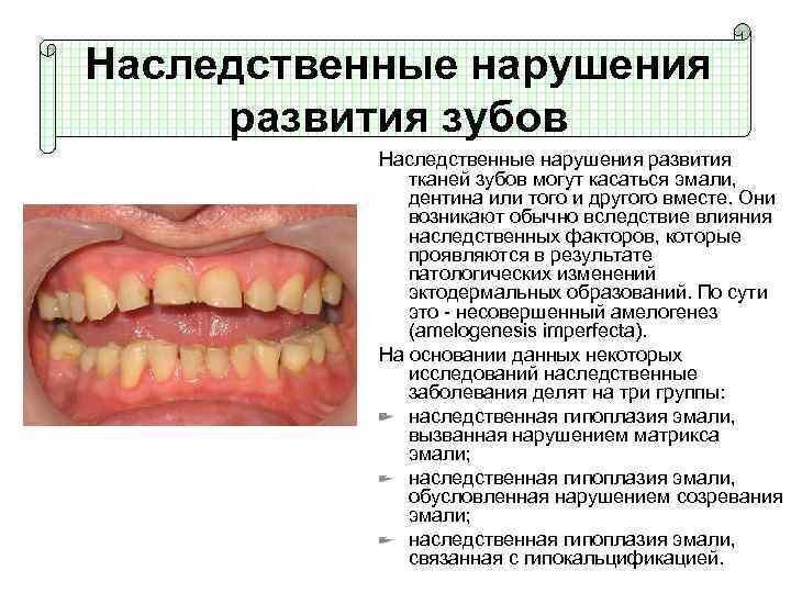 Наследственные нарушения развития зубов Наследственные нарушения развития тканей зубов могут касаться эмали, дентина или