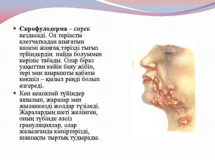  Скрофулодерма – сирек кездеседі. Ол теріасты клетчаткадан шығатын көлемі жаңғақ тәрізді тығыз түйіндердің