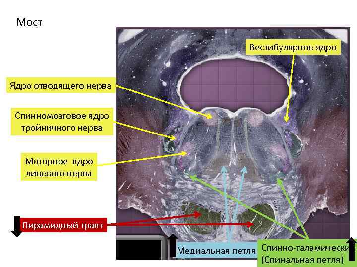 Мост Вестибулярное ядро Ядро отводящего нерва Спинномозговое ядро тройничного нерва Моторное ядро лицевого нерва