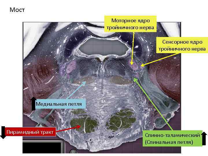 Мост Моторное ядро тройничного нерва Сенсорное ядро тройничного нерва Медиальная петля Пирамидный тракт Спинно-таламический
