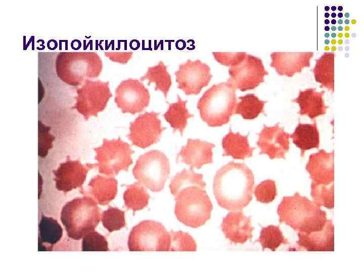 Изопойкилоцитоз 