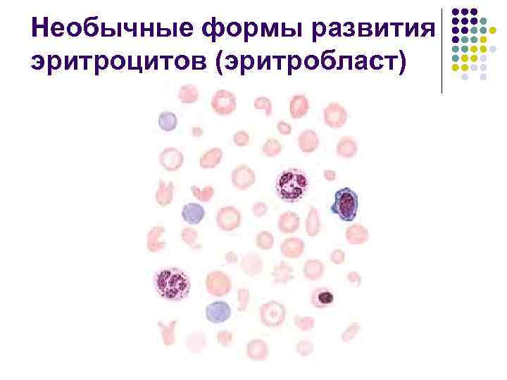 Необычные формы развития эритроцитов (эритробласт) 