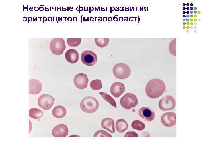 Необычные формы развития эритроцитов (мегалобласт) 