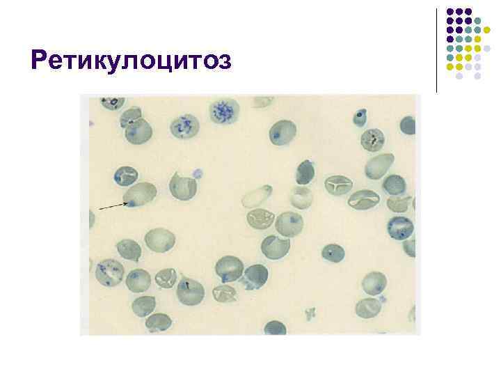 Ретикулоцитоз 