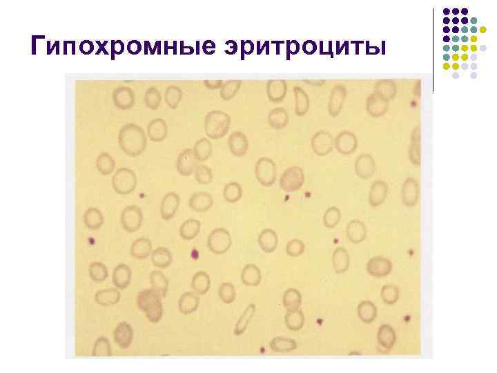 Гипохромные эритроциты 