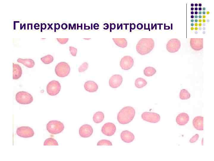 Гиперхромные эритроциты 