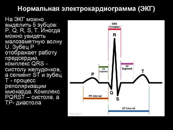 Нормальная электрокардиограмма (ЭКГ) На ЭКГ можно выделить 5 зубцов: P, Q, R, S, T.