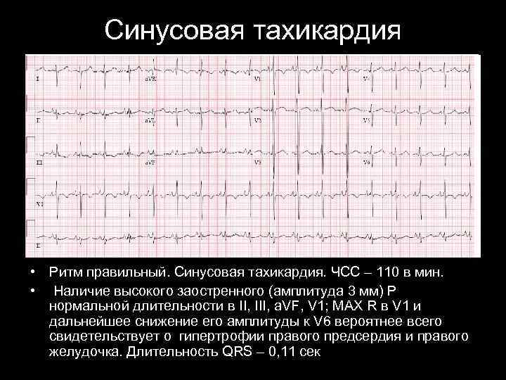 Синусовая тахикардия • Ритм правильный. Синусовая тахикардия. ЧСС – 110 в мин. • Наличие