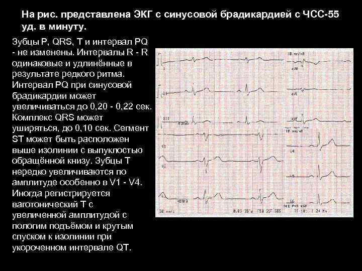 На рис. представлена ЭКГ с синусовой брадикардией с ЧСС-55 уд. в минуту. Зубцы P,