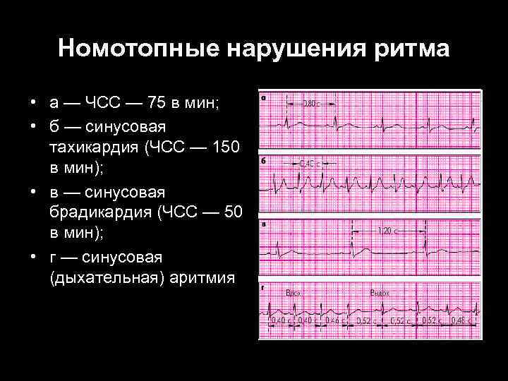 Номотопные нарушения ритма • а — ЧСС — 75 в мин; • б —